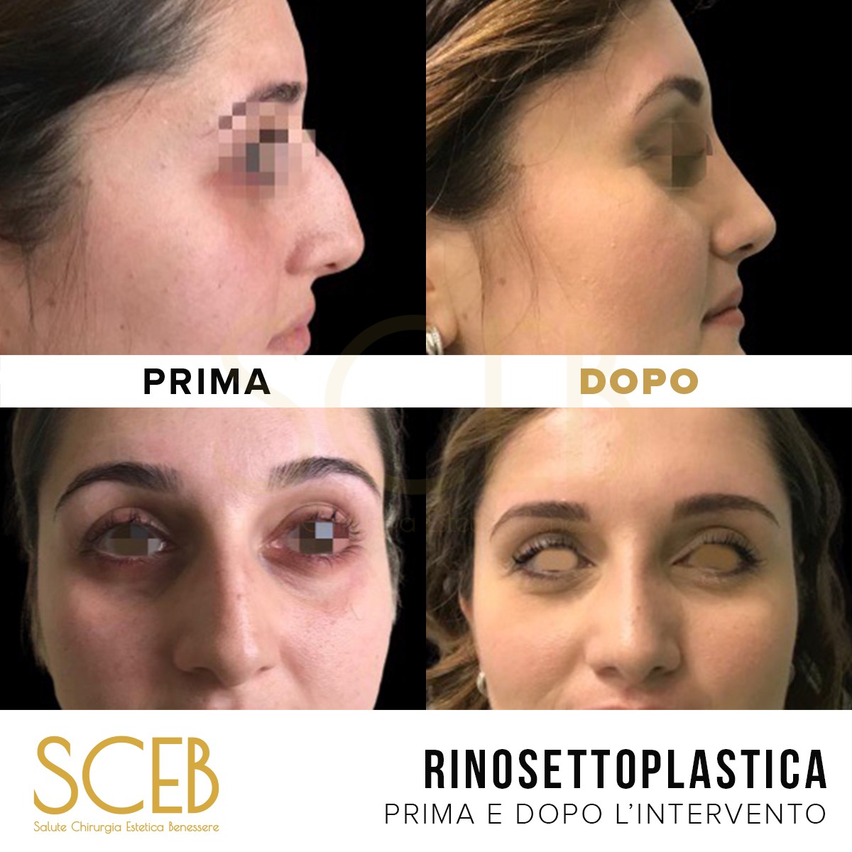 Rinoplastica Prima E Dopo Intervento A Pistoia Firenze Lecce E Bari