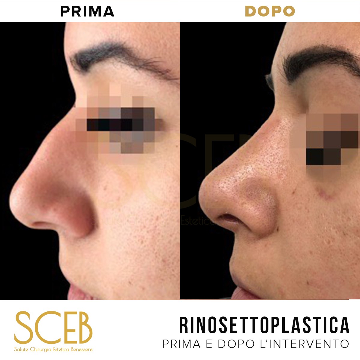 Rinoplastica Prima E Dopo Intervento A Pistoia Firenze Lecce E Bari