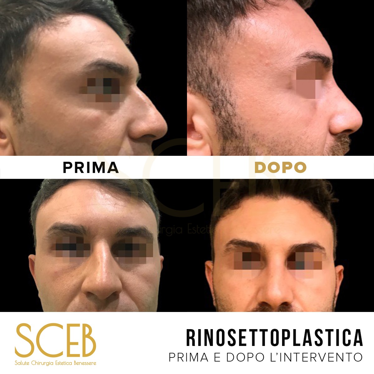 Rinoplastica Prima E Dopo Intervento A Pistoia Firenze Lecce E Bari