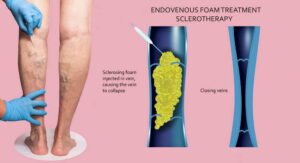 immagine-di-esame-ecocolordoppler-venoso-arti-inferiori