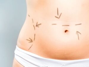 addominoplastica-Siena-centro-chirurgia-plastica-estetica-sceb