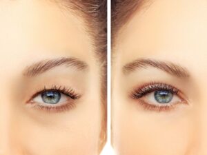 blefaroplastica-Massa-Carrara-centro-chirurgia-plastica-estetica-sceb