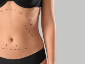liposuzione-Firenze-centro-chirurgia-plastica-estetica-sceb