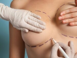 mastopessi-centro-chirurgia-plastica-estetica-sceb (7)