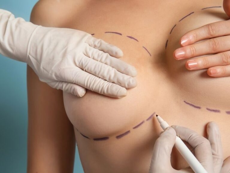 mastopessi-centro-chirurgia-plastica-estetica-sceb (7)