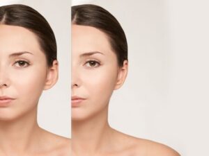otoplastica-Bari-centro-chirurgia-plastica-estetica-sceb